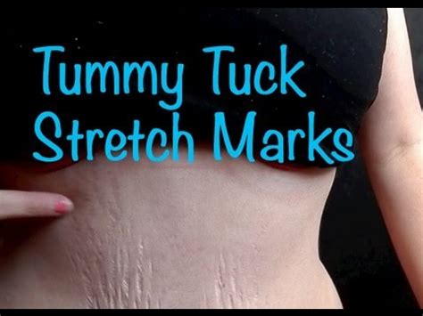 She was 5 feet 6 inches tall and 136 pounds. . Tummy tuck before and after pictures with stretch marks